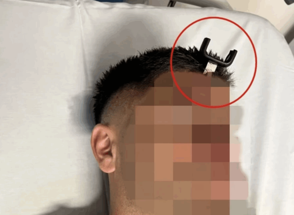 ΣΟΚ! «Κάρφωσαν» κλειδί αυτοκινήτου στο κεφάλι 35χρονου πατέρα