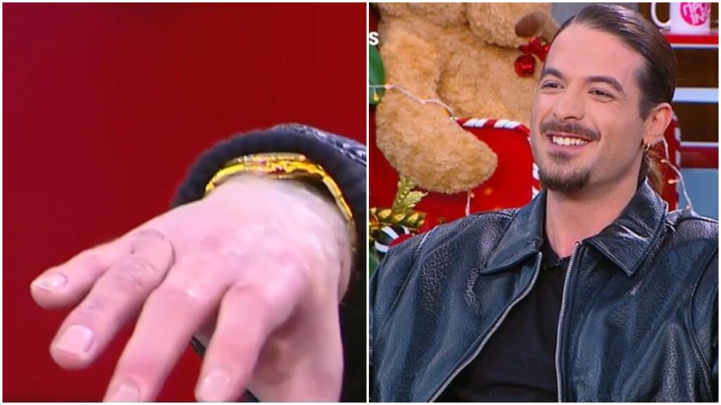 Άρης Μουγκοπέτρος: Δείχνει τα δάχτυλά του μετά το ατύχημα με την κροτίδα – «Θα επιστρέψω»