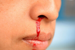 Αιμορραγεί συχνά η μύτη σου; Το «αθώο» σύμπτωμα που μπορεί να κρύβει σοβαρό πρόβλημα υγείας