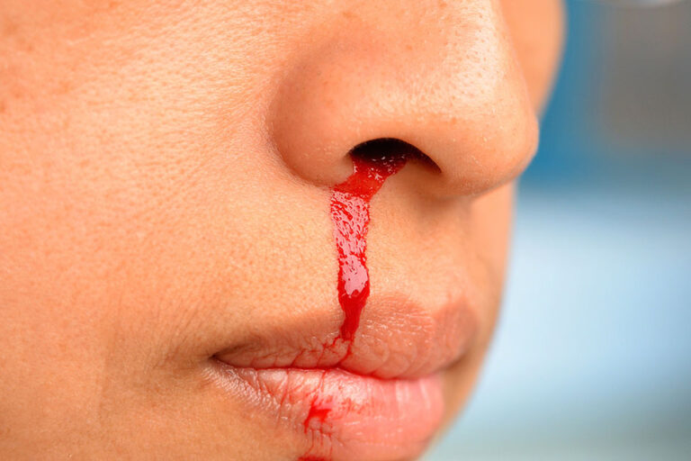 Αιμορραγεί συχνά η μύτη σου; Το «αθώο» σύμπτωμα που μπορεί να κρύβει σοβαρό πρόβλημα υγείας