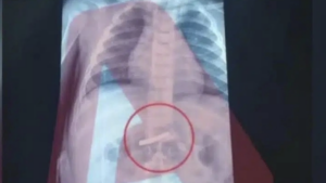 Στο νοσοκομείο Παίδων 3χρονο αγόρι – Τι σοκαριστικό κατάπιε