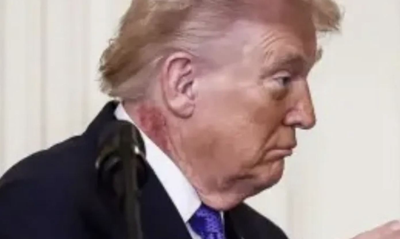Τι συμβαίνει με τον Τραμπ; – Η αλήθεια για το εξάνθημα που έχει στο λαιμό του