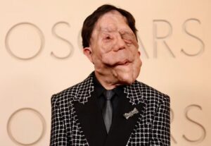 Αδιανόητη ασθένεια για πασίγνωστο παρουσιαστή – Εμφανίστηκε έτσι στα Όσκαρ